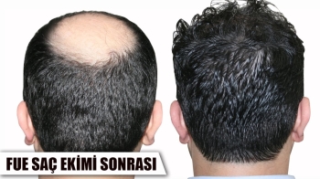 FUE Saç Ekimi Nedir?