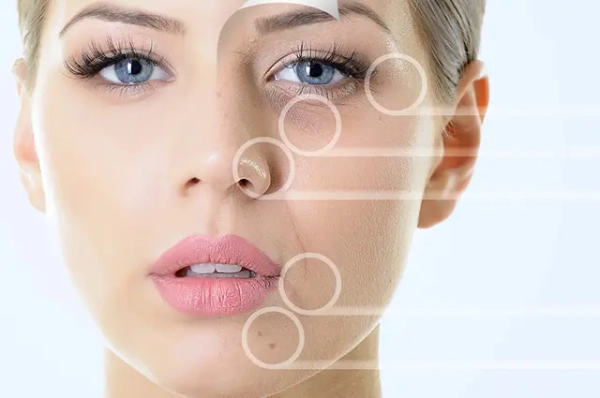 Kimyasal Peeling Sonrası Bakım